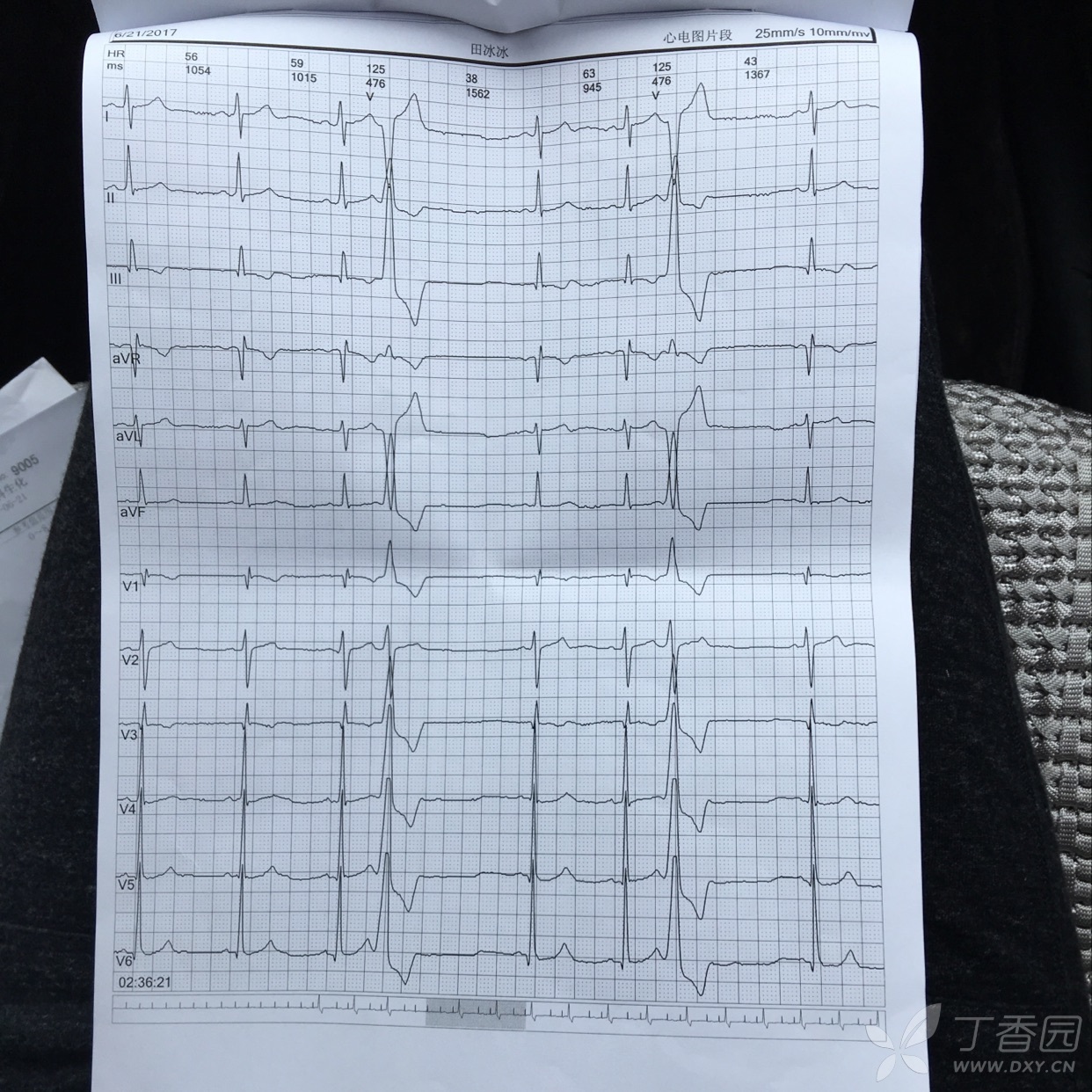 各位老师帮忙看看动态心电图结果,看看属于室性早搏来源