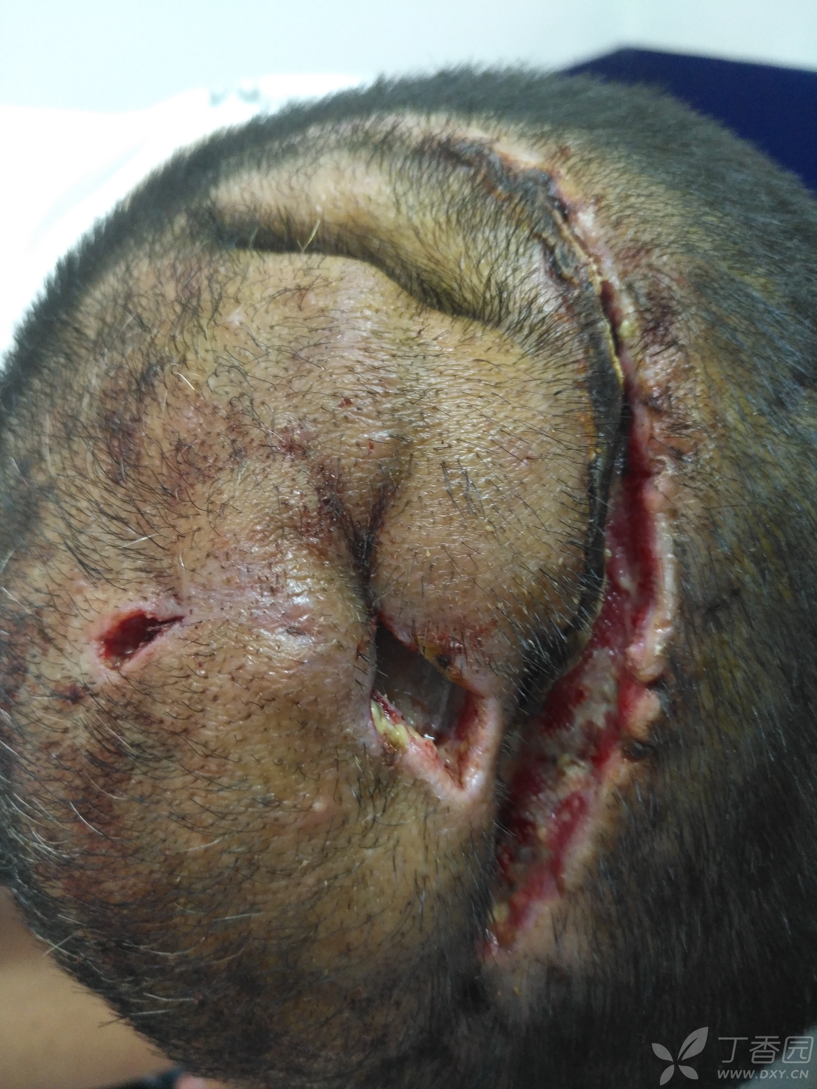 头部脂肪瘤术后感染切口裂开