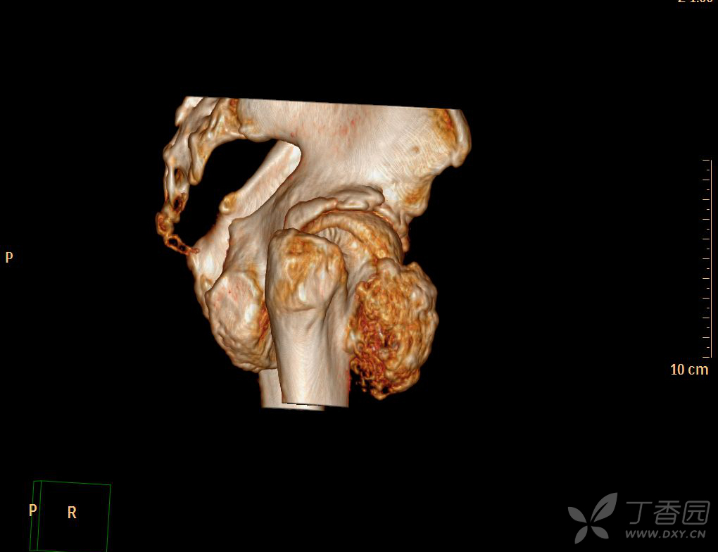 骨盆,右股骨近端骨软骨瘤? [病例帖]