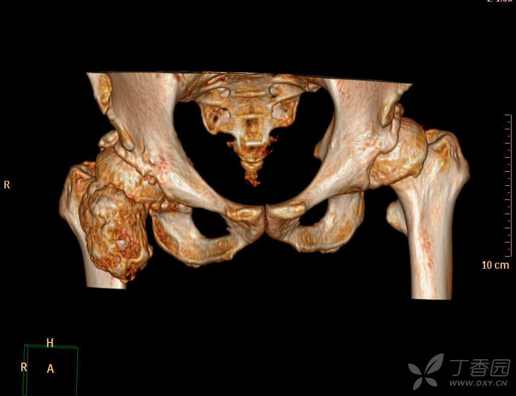 骨盆,右股骨近端骨软骨瘤? [病例帖]