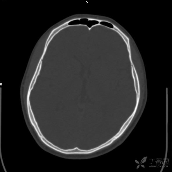 颅骨内板骨软骨瘤伴蛛网膜囊肿?