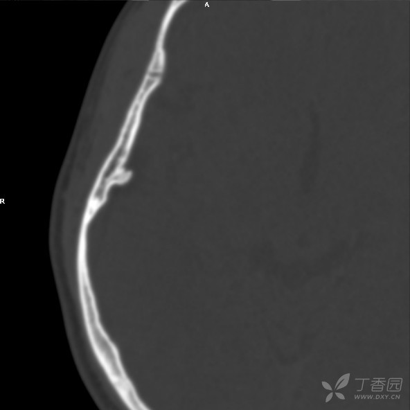 颅骨内板骨软骨瘤伴蛛网膜囊肿?