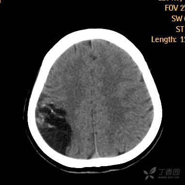 头,右侧枕顶叶脑软化灶[病例帖]