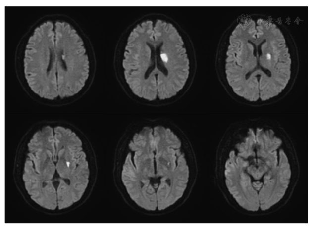 影像 3 内侧豆纹动脉梗死模式图内侧豆纹动脉起于大脑中动脉 m1 段近