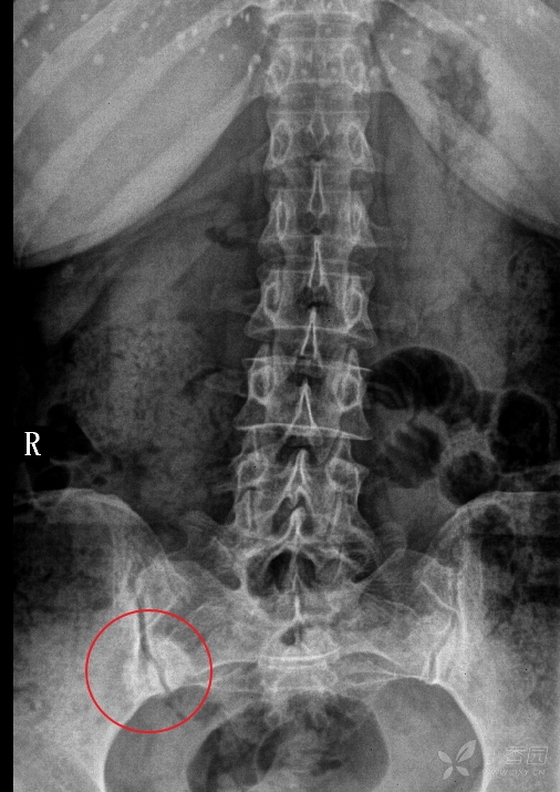腰骶部疼痛数月.片示,右侧骶髂关节圆形致密影.考虑髂骨致密性骨炎.