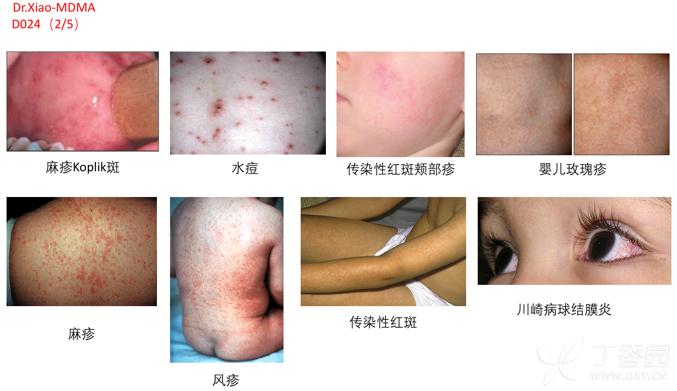 dr.xiao-mdma系列 小儿发热性皮疹(d024)