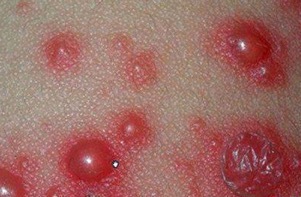 带状疱疹以群集性水疱多见,仅有丘疹而无水疱者少见,容易被忽略