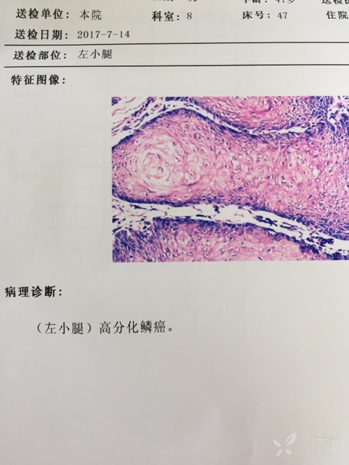 皮肤高分化鳞癌,如何处理 [病例帖]