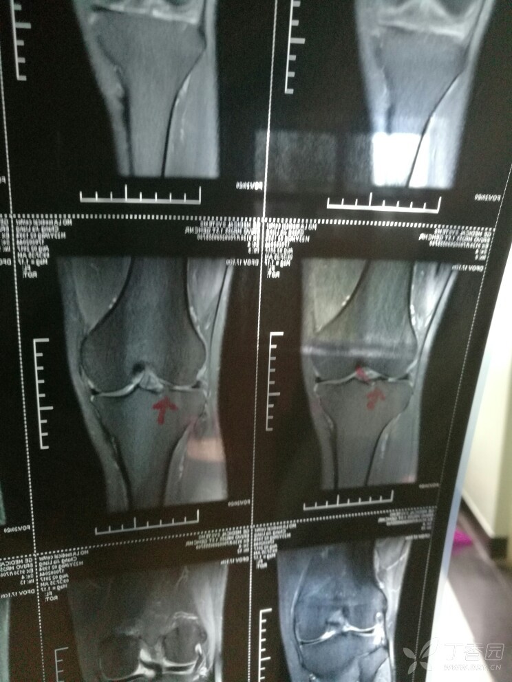 请教老师们半月板损伤如何治疗