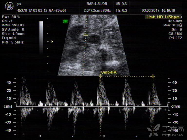 胎儿23w ,主动脉弓离断 - 超声医学讨论版 -丁香园论坛