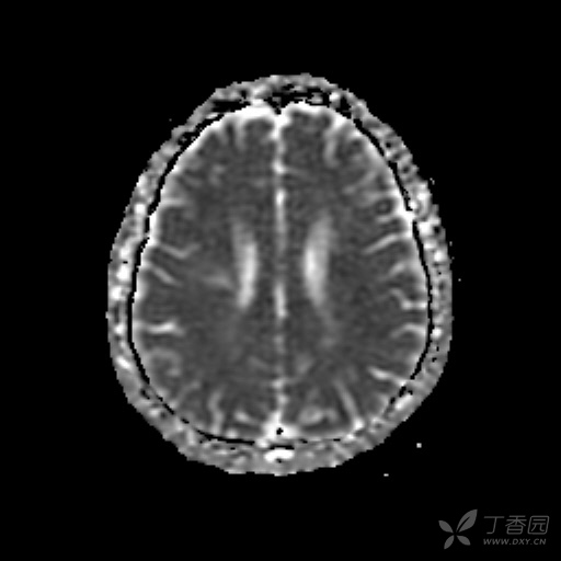 让人困惑的右侧放射冠"脑出血"一例 [病例帖]