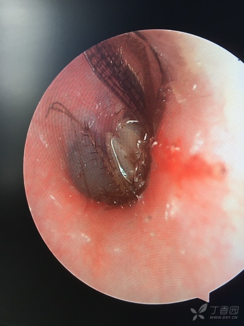 入院查体 :右耳廓外形正常,耳道充血,贴近鼓膜处见一昆虫,鼓膜窥不全