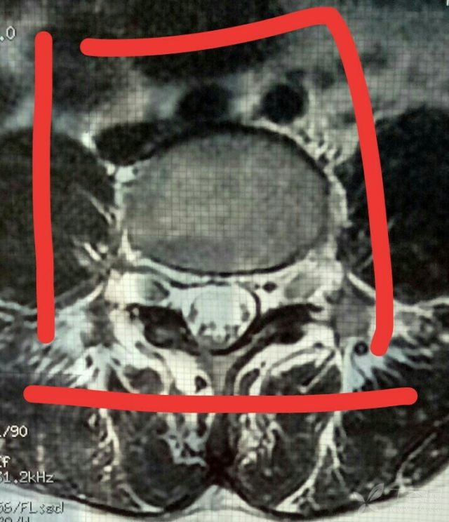 腰椎间盘突出压硬囊膜,症状也复杂多变,不知如何诊断治疗?