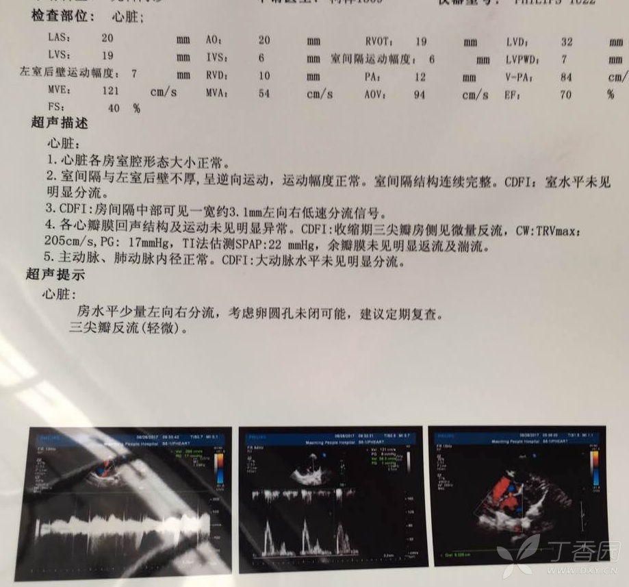 卵圆孔未闭需不需要手术治疗