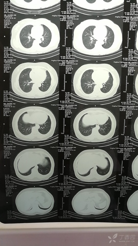 我母亲的肺部ct,结合会是癌吗? [病例帖]