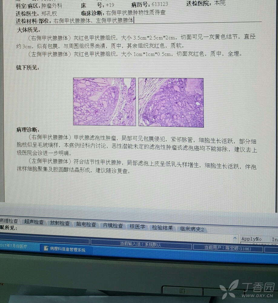 甲状腺滤泡肿瘤病理,求助