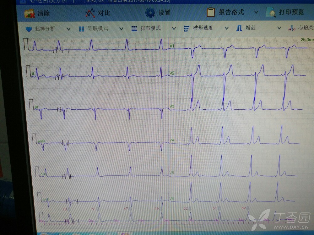 请教各位老师预激综合征心电图,谢谢大家,非常感谢