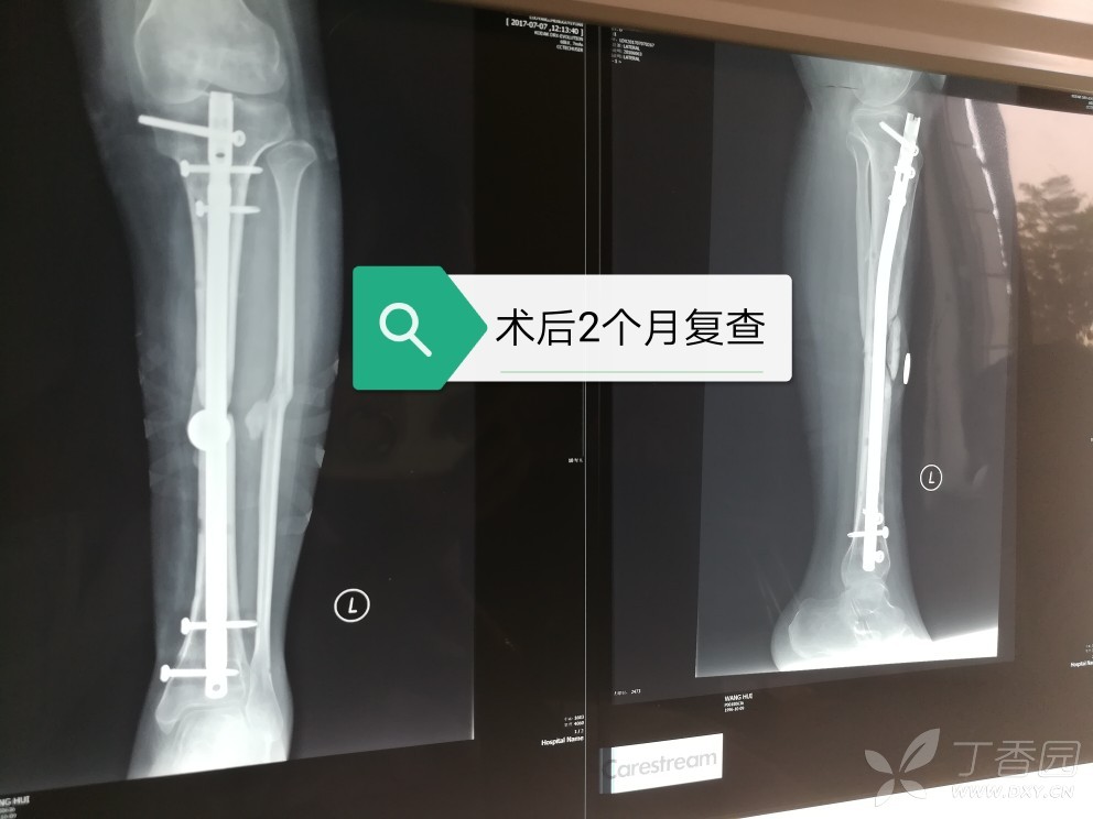 胫骨髓内钉 [病例帖]