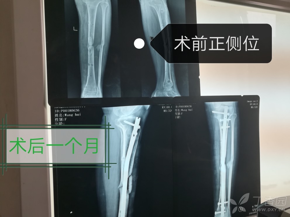 胫骨髓内钉 [病例帖]
