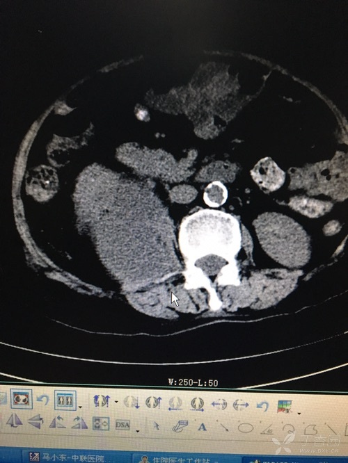 腹膜后位阑尾周围脓肿la一例 [病例帖]