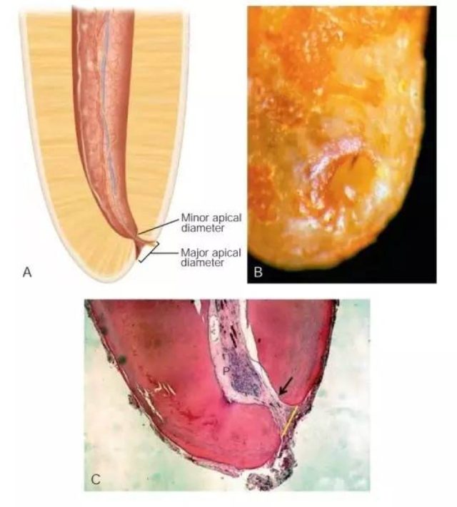 a-根尖狭窄和根尖孔的图示;b-根尖孔的临床照片;c-组织切片展示的根尖