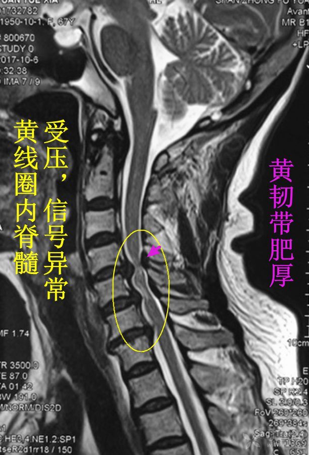 一例多阶段脊髓型颈椎病,大家看看