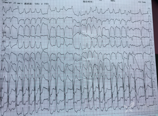 患者出现反复尖端扭转室速,罪祸何在? [病例帖]