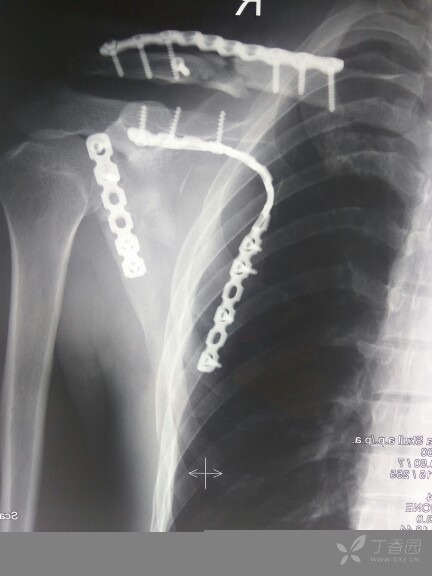 小医首例肩胛骨骨折orif治疗. [病例帖]