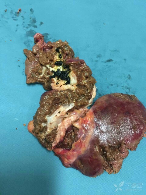 左肝内胆管结石合并胆囊结石及胆总管结石患者,各位胆