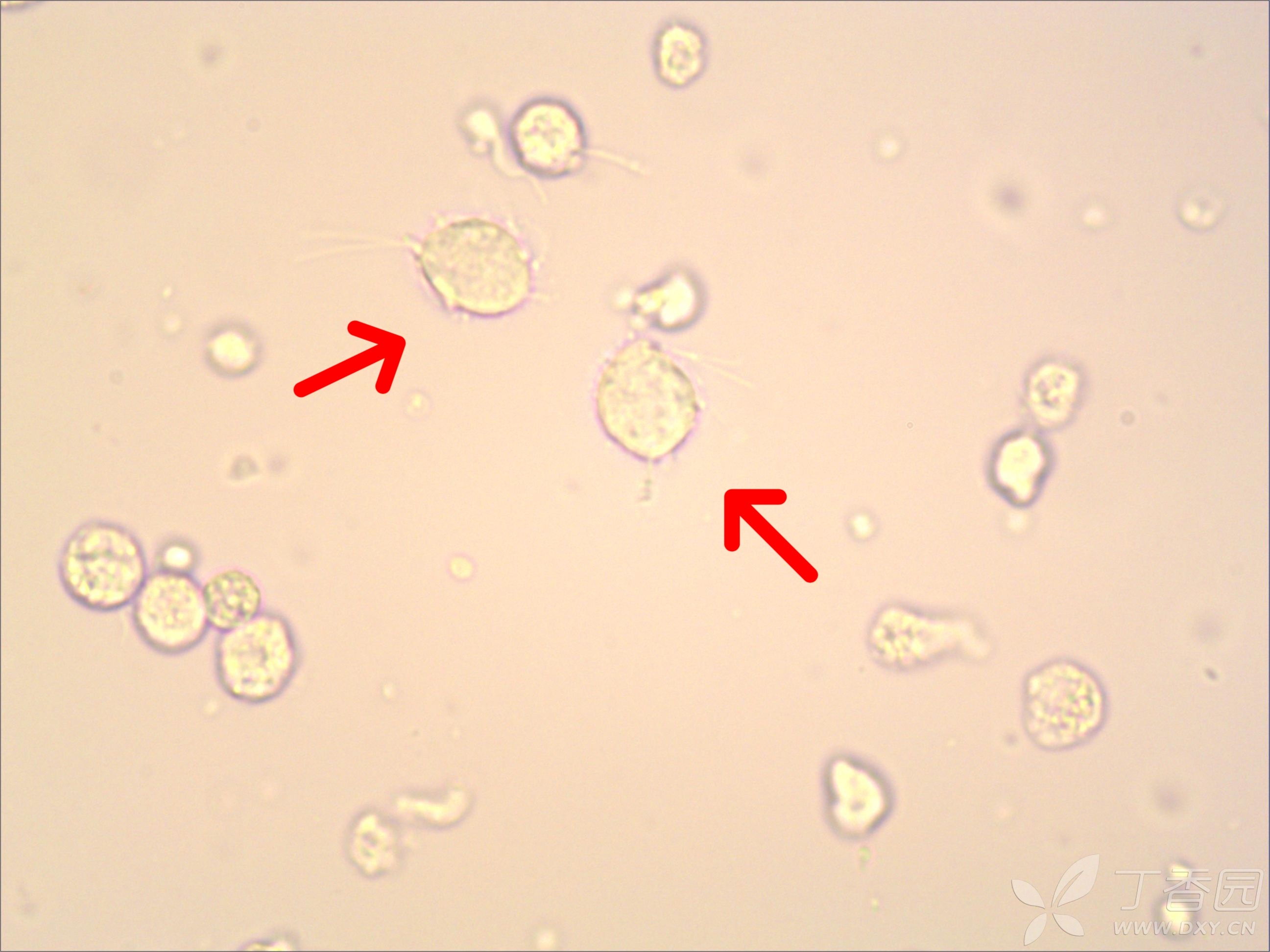 美图分享3——滴虫和真菌(尿液标本)