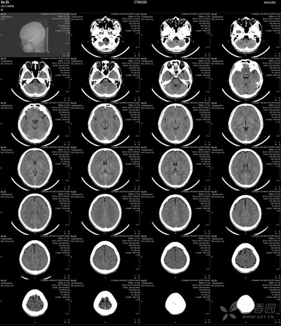 脑部ct平扫,大家能看出什么问题? [病例帖]