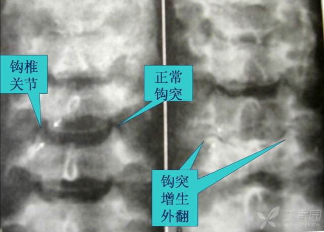 我看书时有时会看到这个,钩突关节增生可以理解会压迫神经根,但变尖是