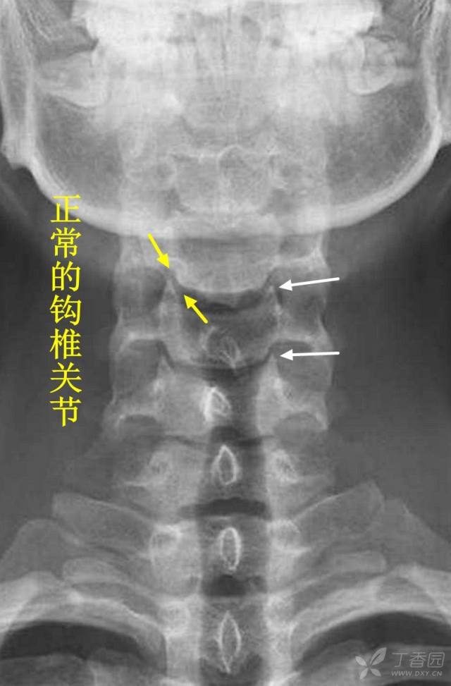 (白箭),或略圆钝,钩突及上一椎体钩突关节骨性关节面无明显硬化(黄箭)