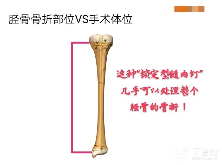 胫骨干骨折钢板髓内钉固定之争何时休?