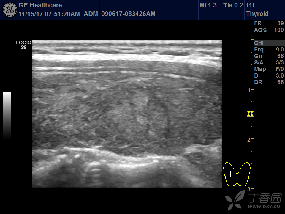 桥本甲状腺炎 超声医学讨论版-丁香园论坛