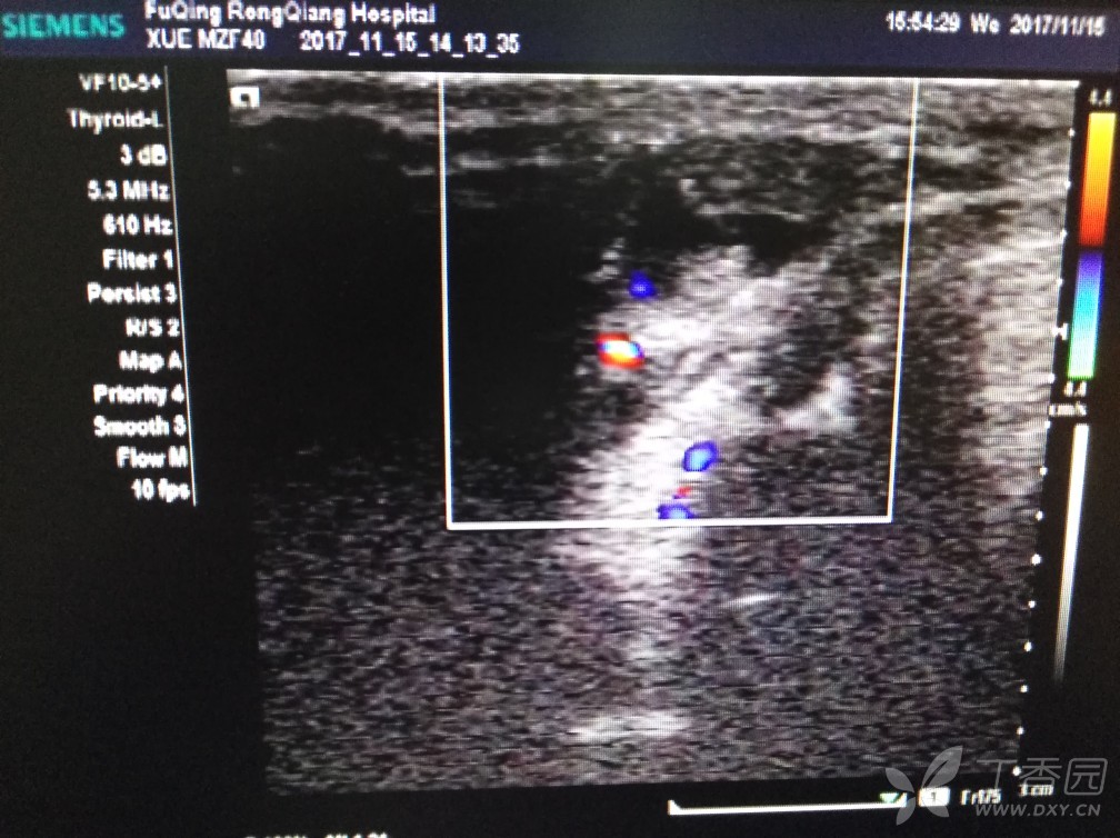 甲状舌管囊肿并感染? - 超声医学讨论版 -丁香园论坛