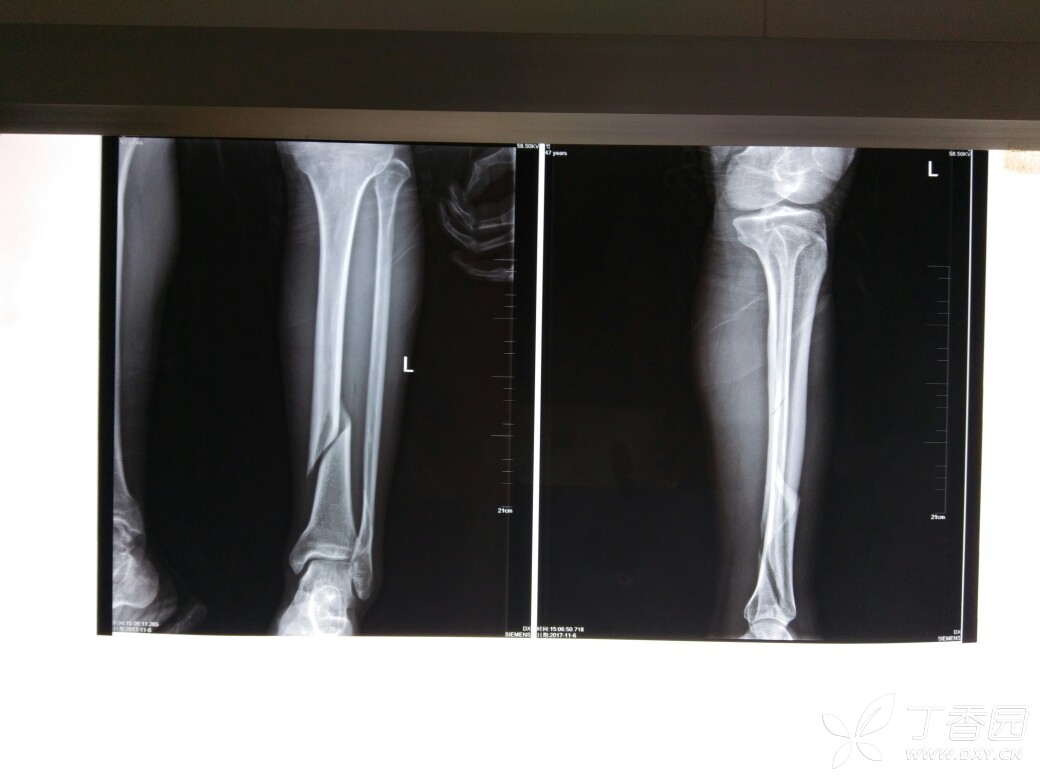 左桡骨远端骨折,打石膏刚好一个月,今天拆了石膏