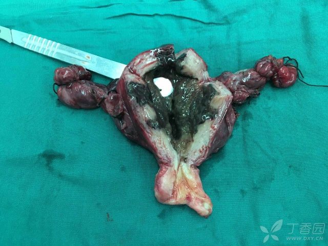 这是史上切口最敞亮的子宫切除术切下的子宫——从剑突下到耻骨上.