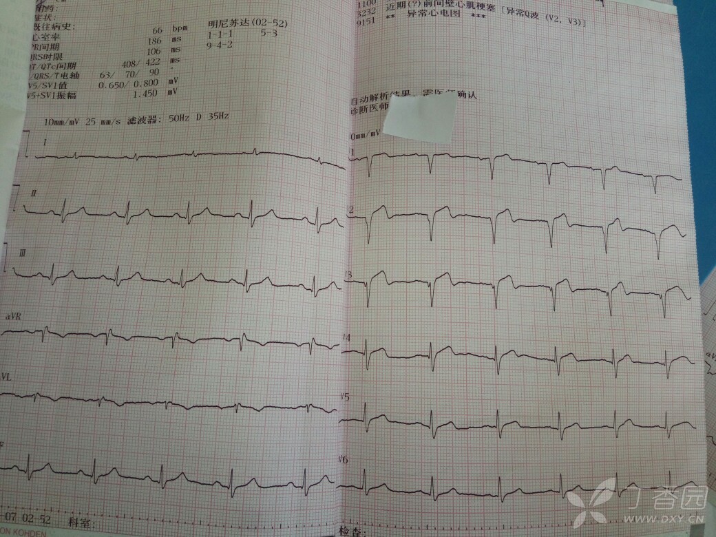 典型急性心肌梗死心电图演变,速围观 [病例帖]