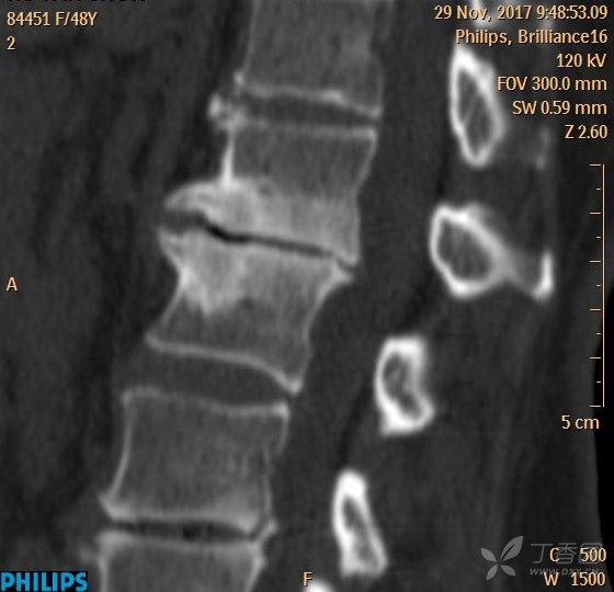腰1/2椎体终板炎 影像核医学-丁香园论坛