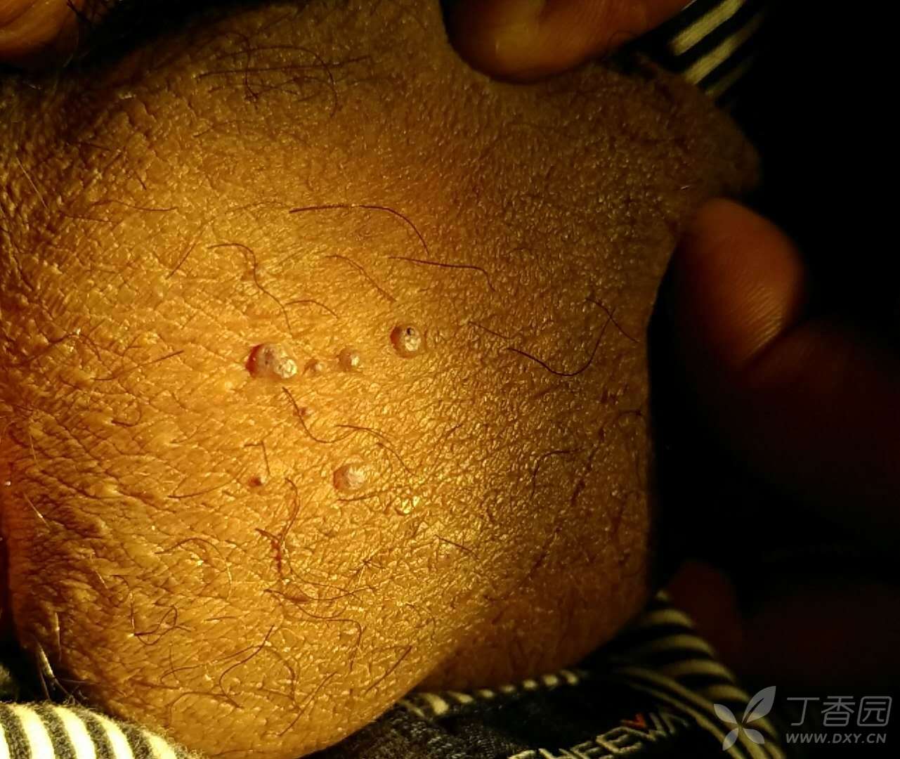 43 简要病史:患者无明显诱因,近二个月发现阴囊处长十余个扁平状丘疹