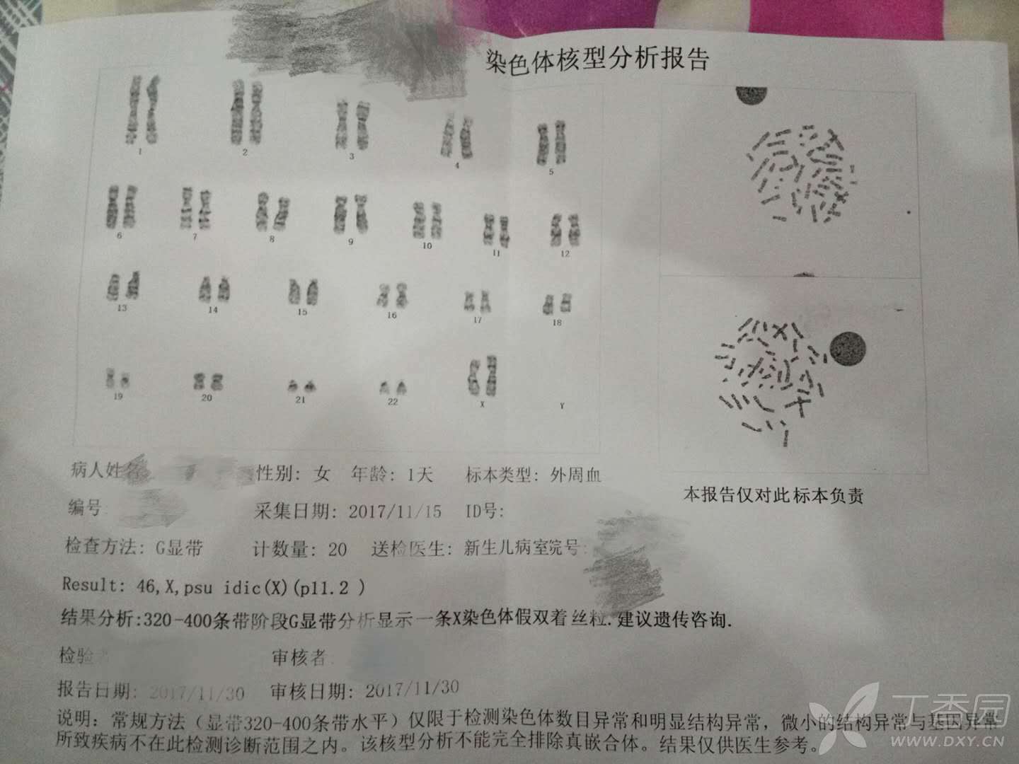 求助:染色体核型分析报告,结果显示一条x染色体假双着丝粒,什么意思?