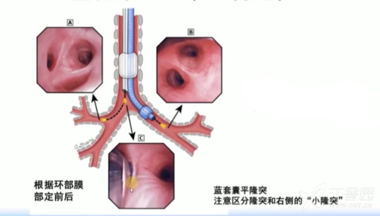 双腔支气管导管定位,难吗?那是你没找对方法好好练习!