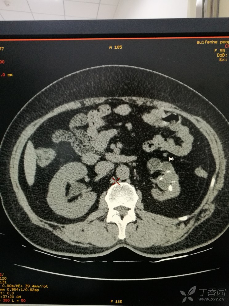 左肾结核?请各位老师看一看.