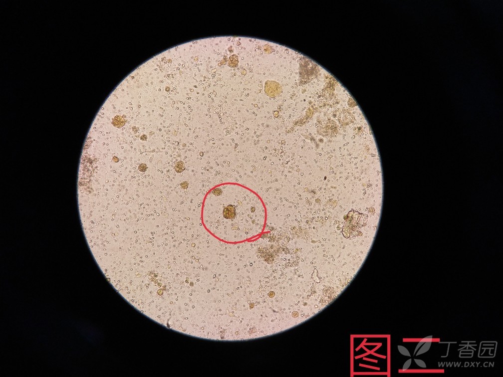 求助大便镜检下的一些有形成分