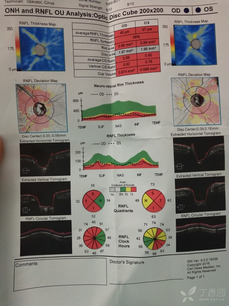 双眼压持续18左右徘徊,担心视神经受损,至今2个半月做的oct,图如下