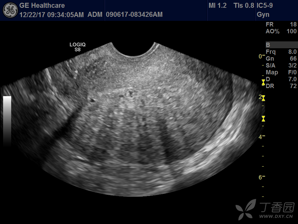 经典型子宫腺肌症 - 超声医学讨论版 -丁香园论坛
