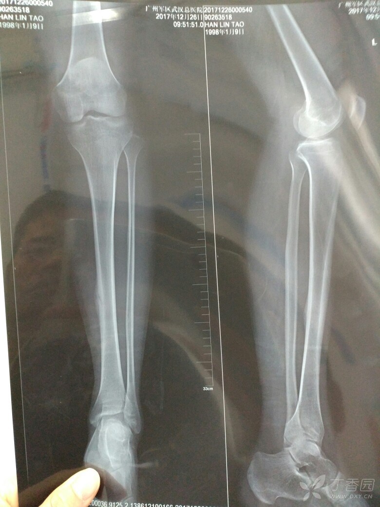 左侧胫骨中下段疲劳性骨折一例 - 骨科专业讨论版