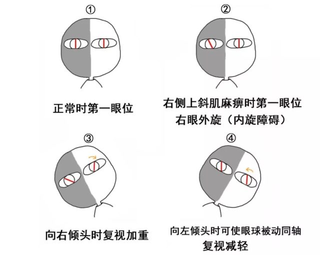 及其代偿性头部姿势 图为右眼上斜肌麻痹(仅示意眼球内外旋及其代偿)