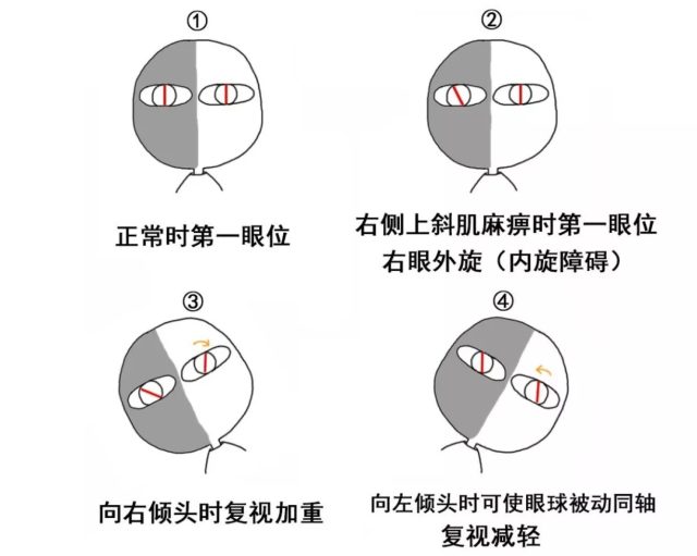 图为右眼上斜肌麻痹(仅示意眼球内外旋及其代偿)